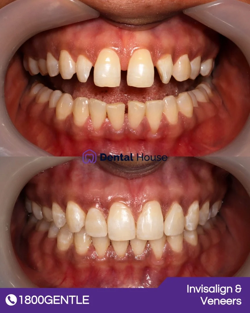 Invisalign & Veneers