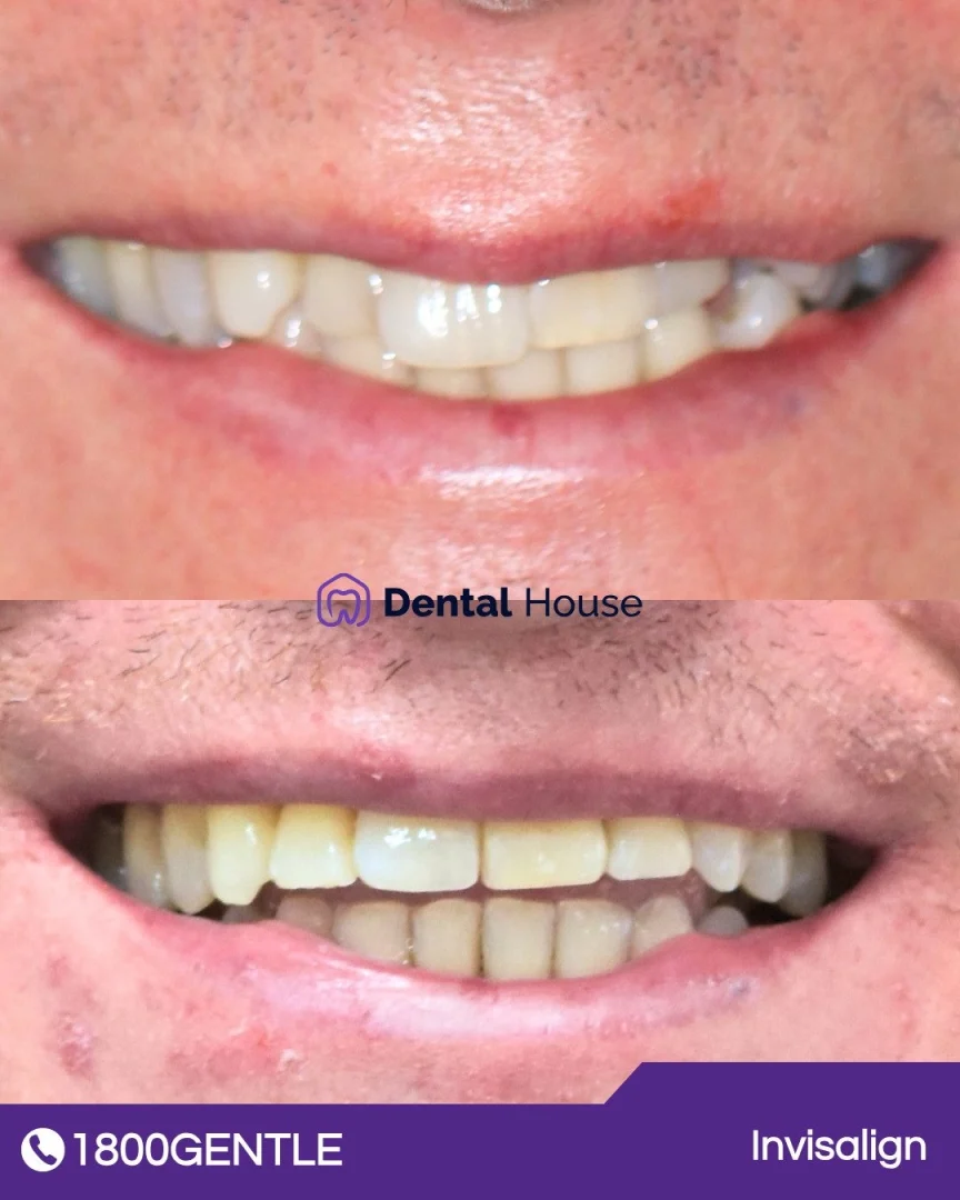 Invisalign