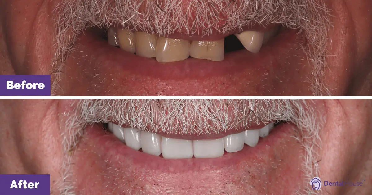 ohn's Smile Makeover in Taylors Lake