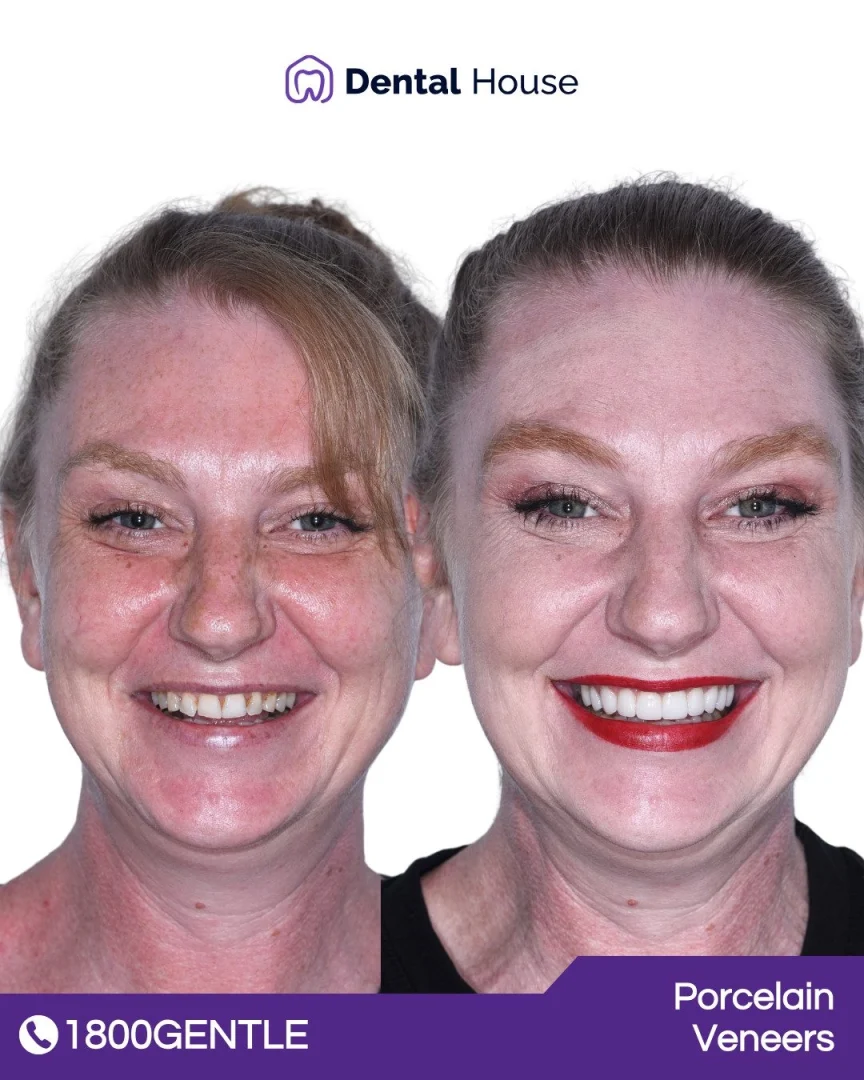 Porcelain Veneers
