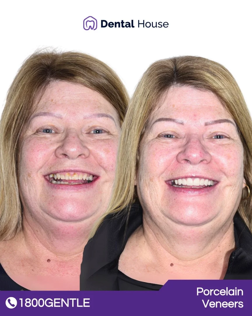 Porcelain Veneers