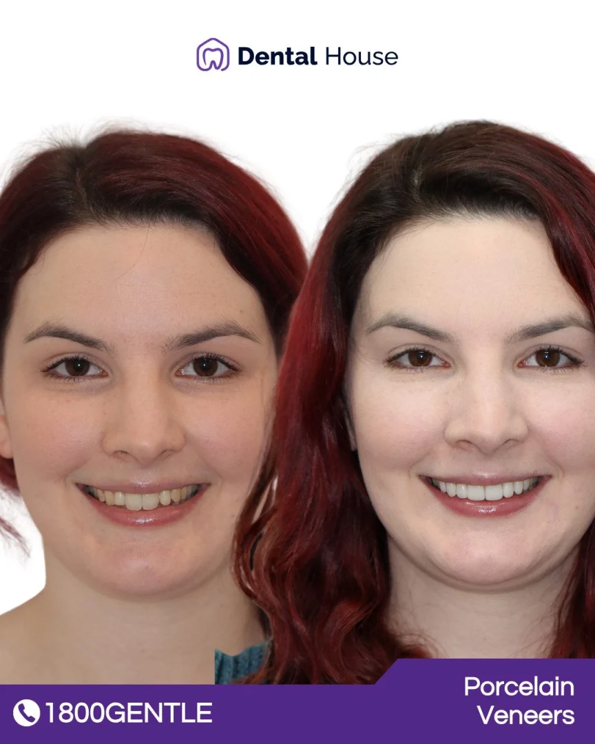 Treatment: Porcelain Veneers