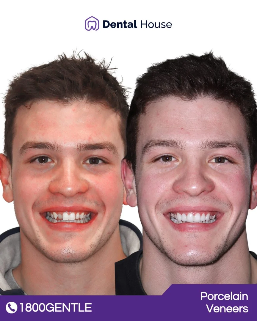 Porcelain Veneers