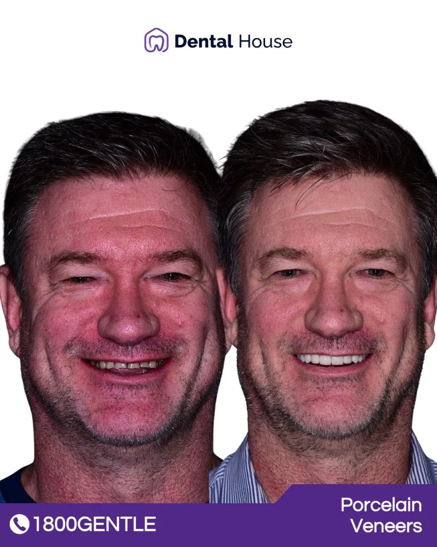 Porcelain Veneers