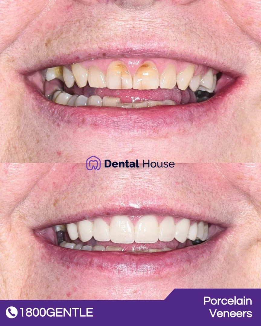 Porcelain Veneers