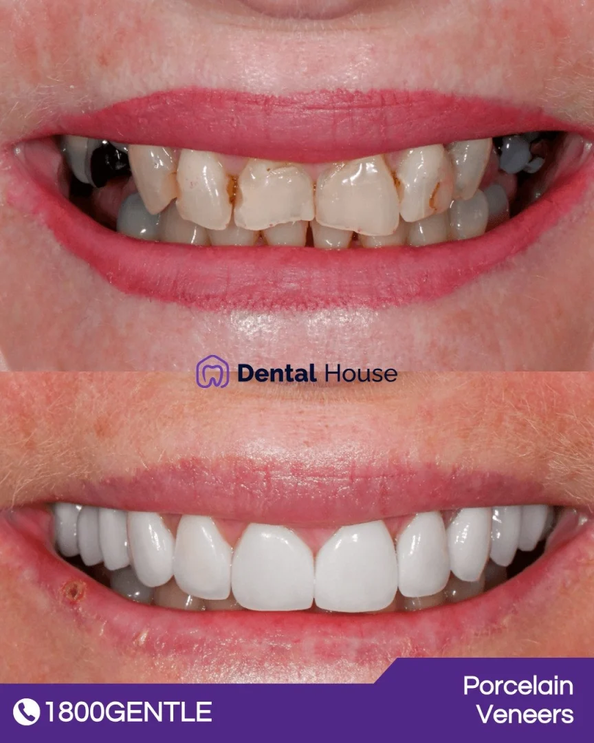 Porcelain Veneers