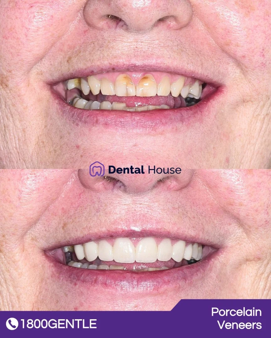 Porcelain Veneers