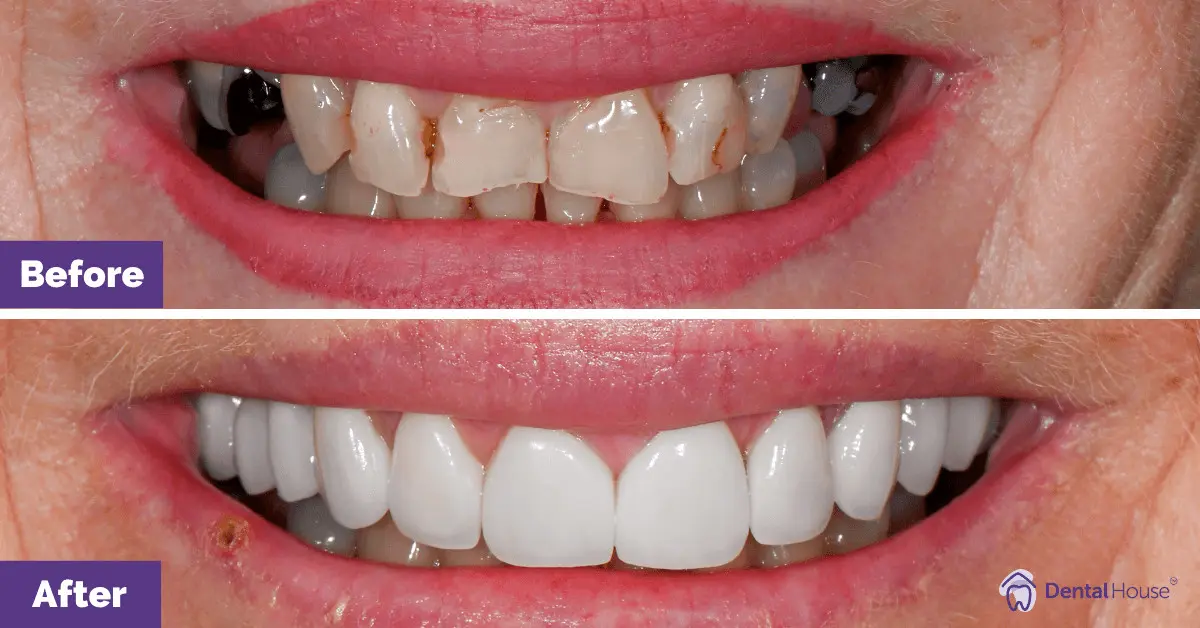 Porcelain Veneers, Dental Crown in DHG