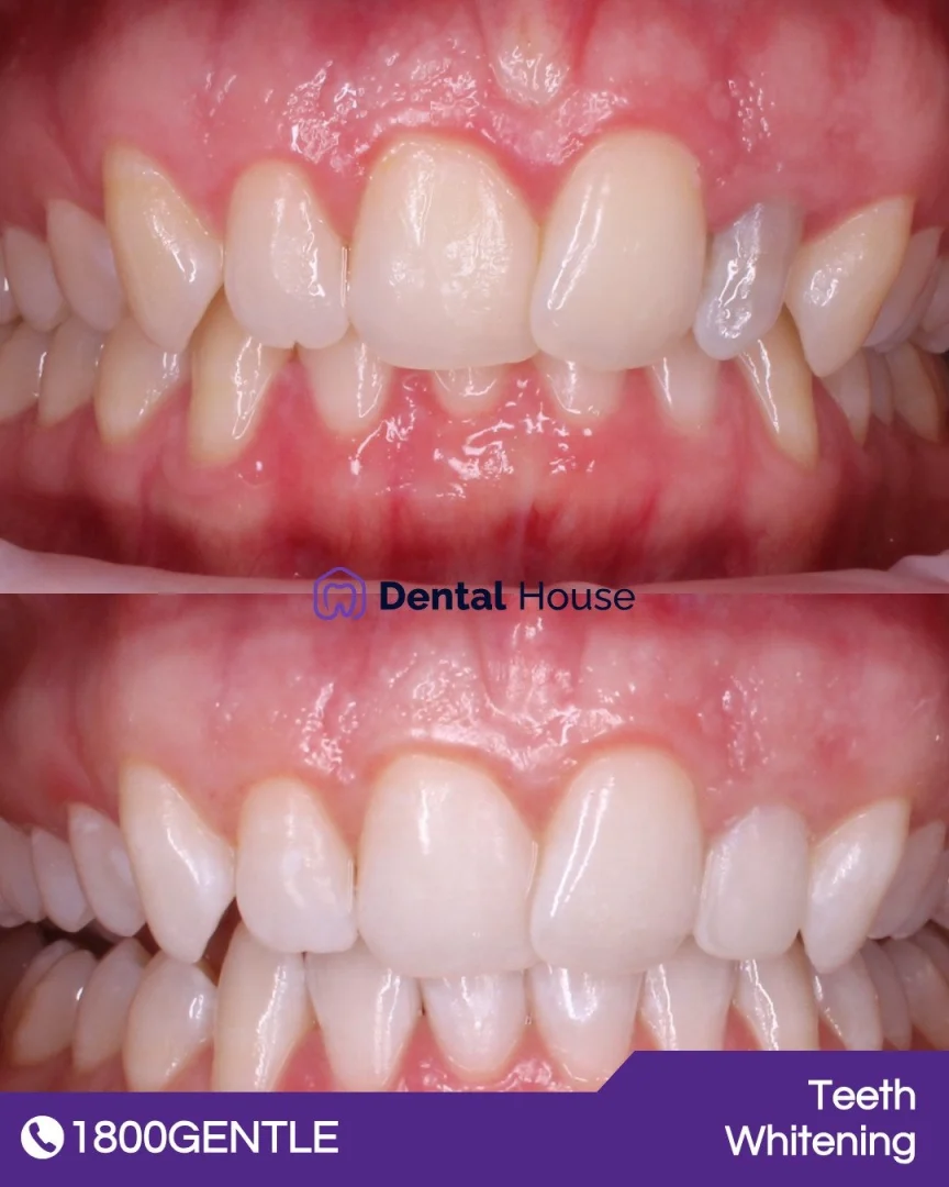 Invisalign & Teeth Whitening