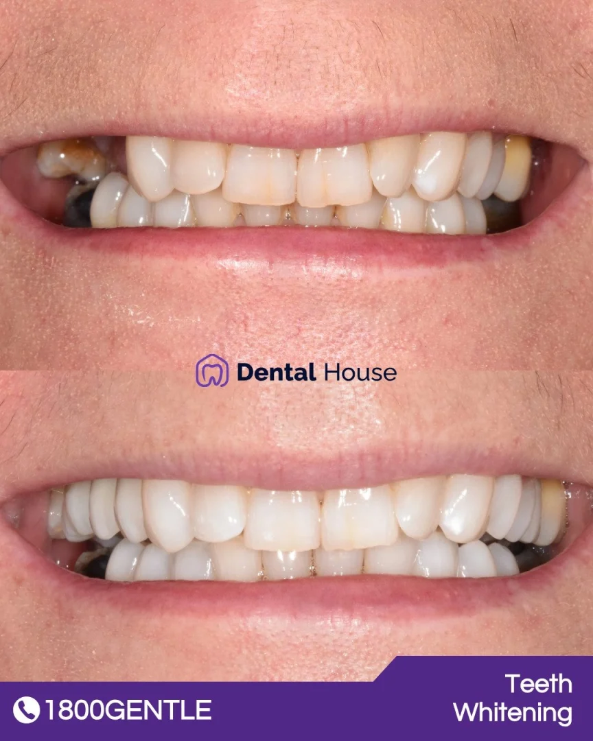 Teeth Whitening & Dental Implant