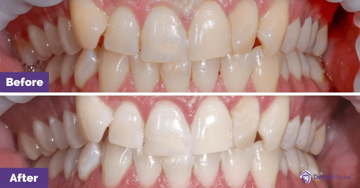 Zoom Whitening in DHG #1