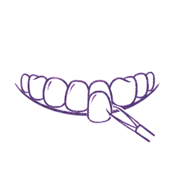veneers